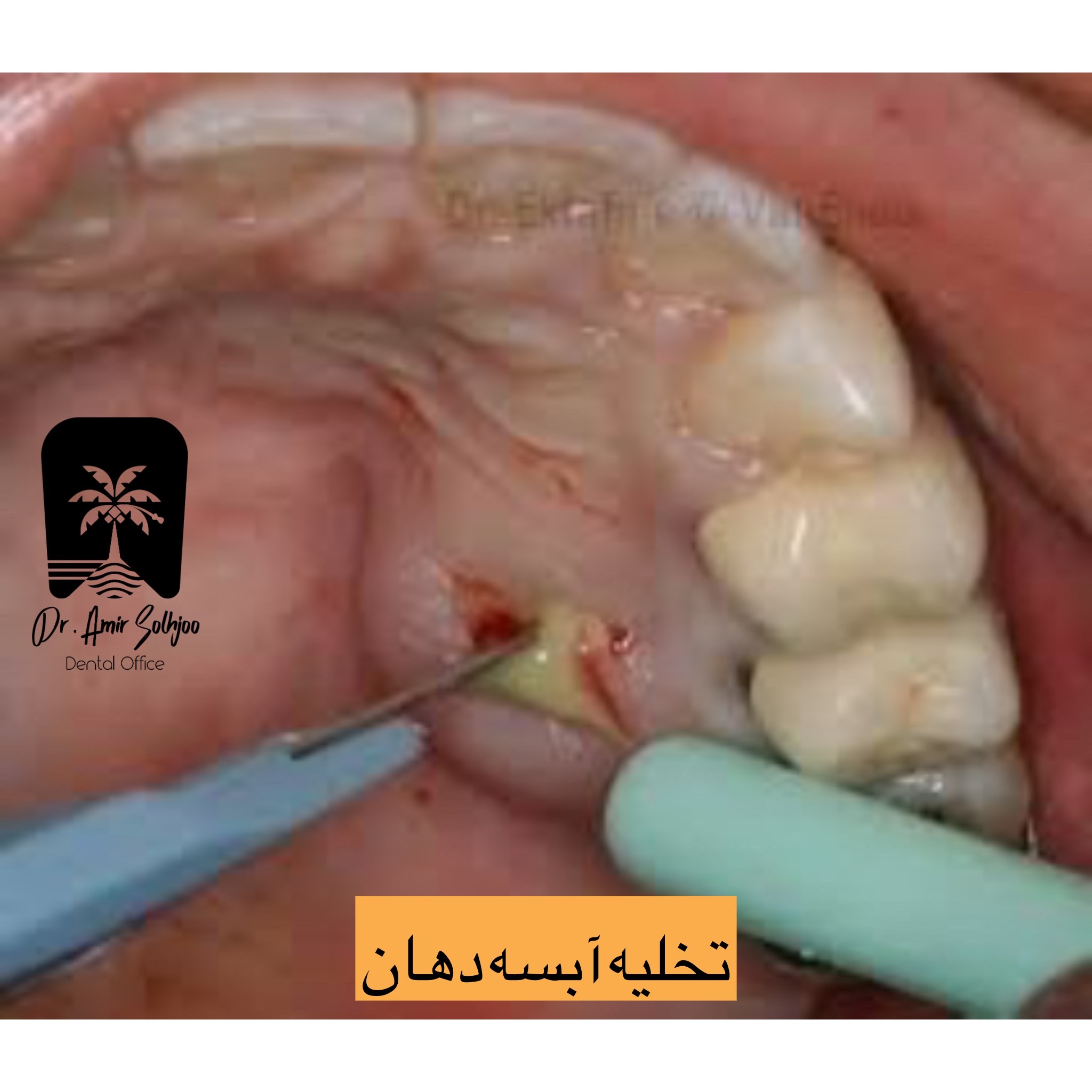 نقش تخلیه آبسه در جلوگیری از پیشرفت عفونت