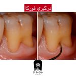 درگیری فورکا دندان