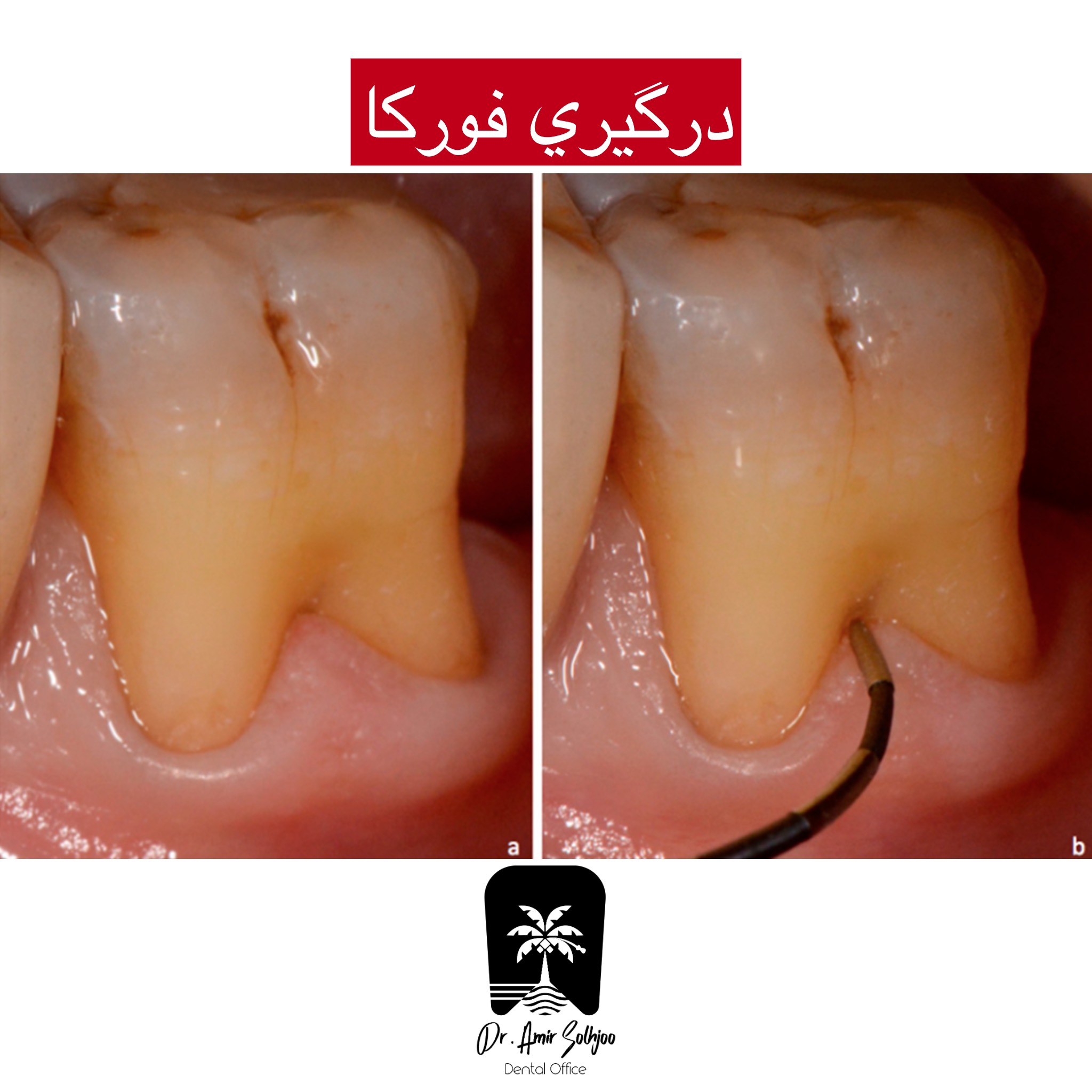 درگیری فورکا دندان