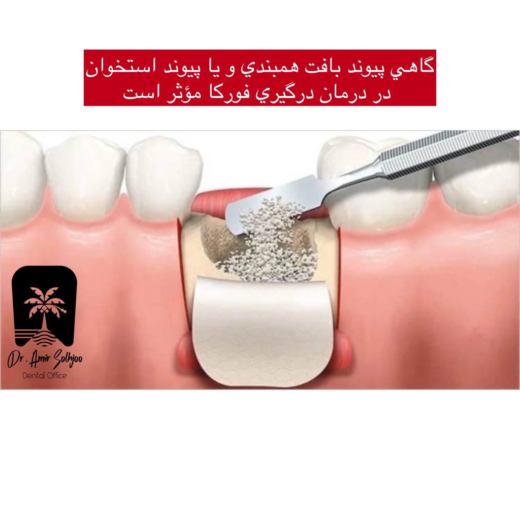پیوند استخوان برای درگیری فورکا