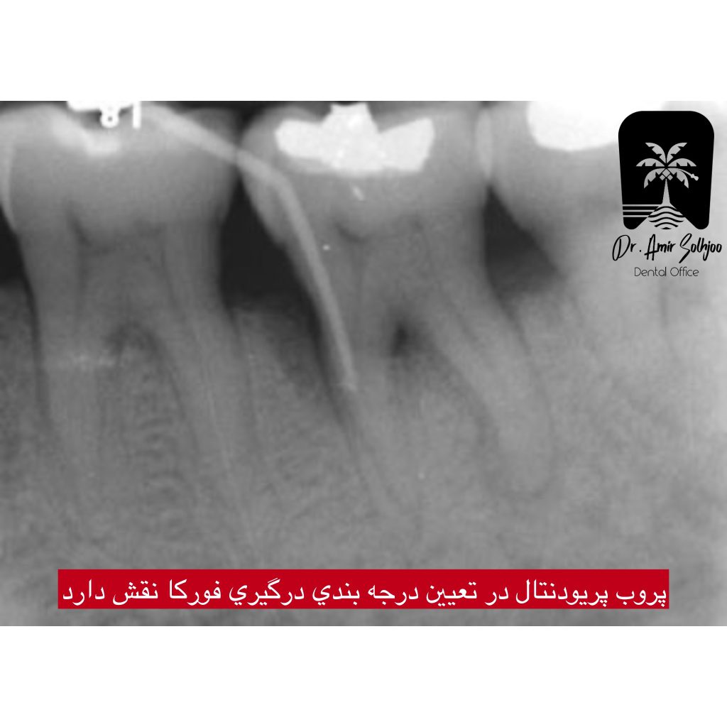 عکس فورکا دندان