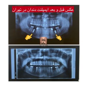 ایمپلنت اورژانسی در غرب تهران