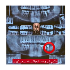 عکس ایمپلنت