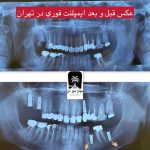 ایمپلنت در یک دقیقه