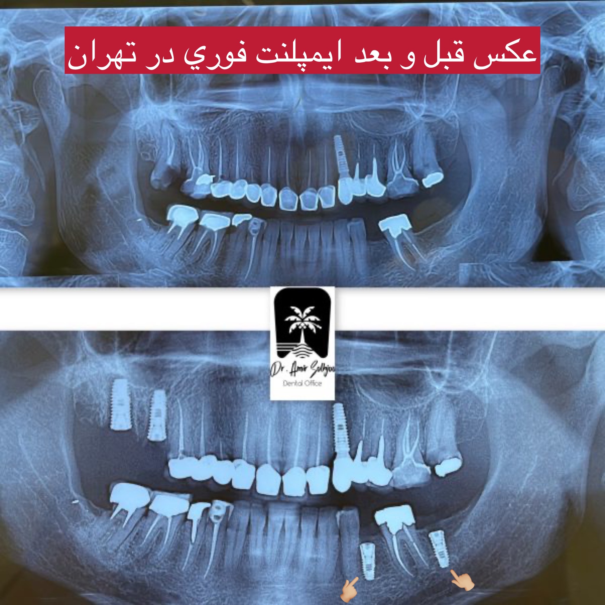 ایمپلنت در یک دقیقه
