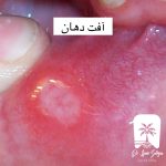 آفت دهان