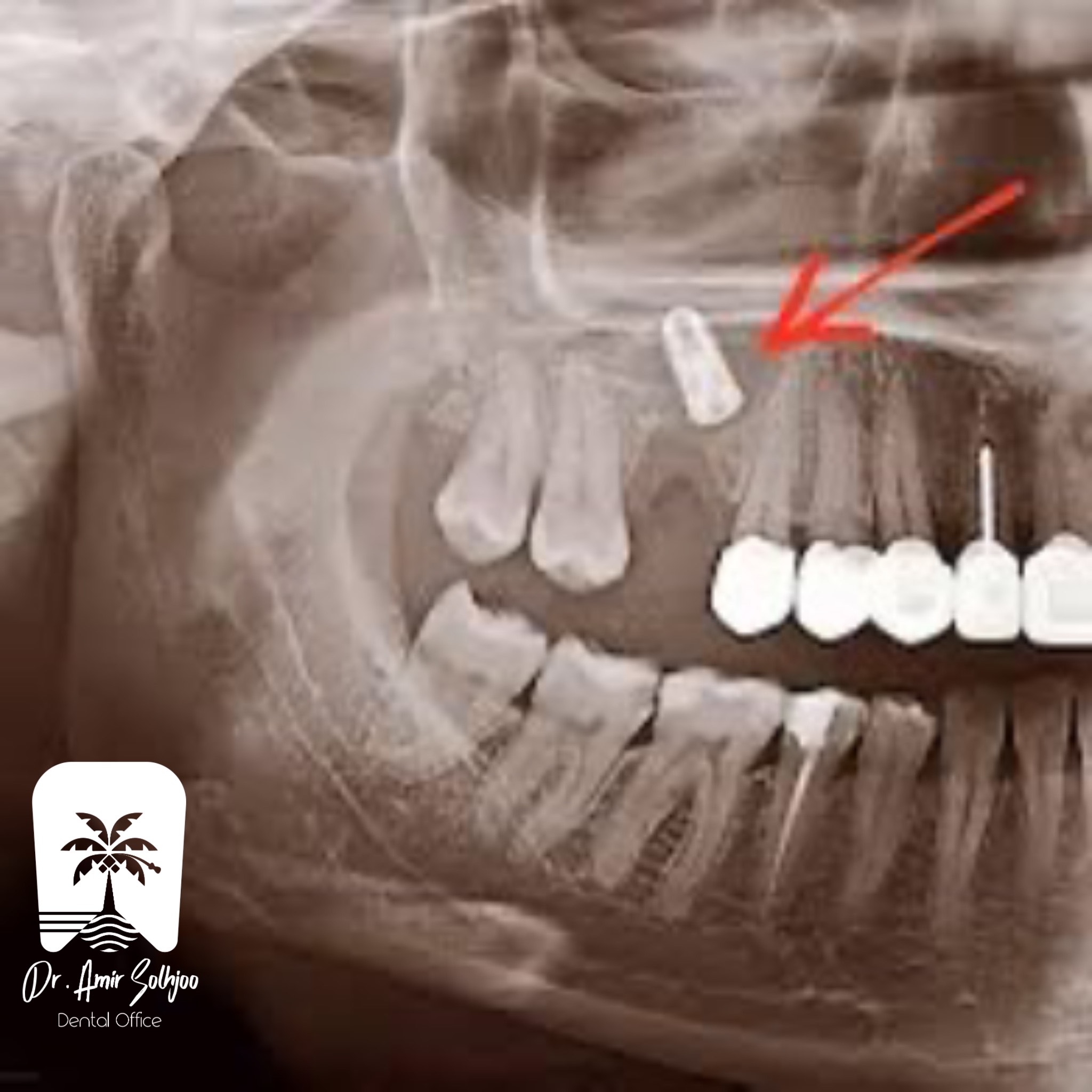 Iranian implant photo