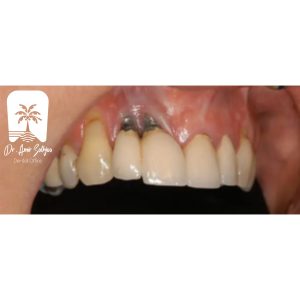 ایمپلنت ایرانی