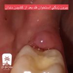 درمان بیرون زدگی استخوان فک: