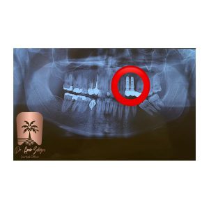 عکس ایمپلنت دندان