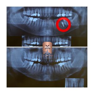 انتخاب یک دندانپزشک خوب برای ایمپلنت