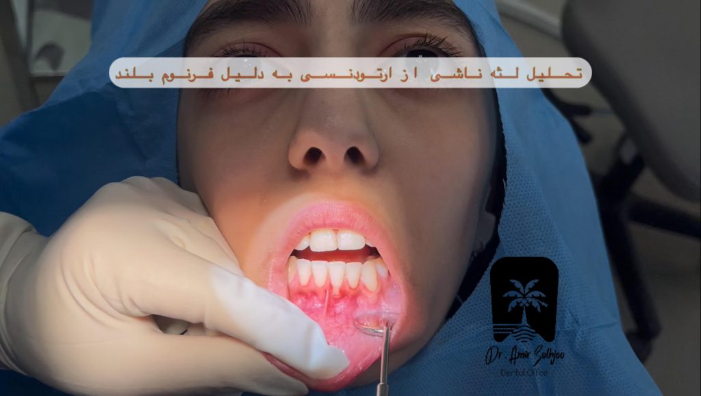 تحلیل لثه