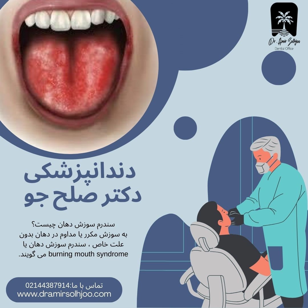 سندرم سوزش دهان