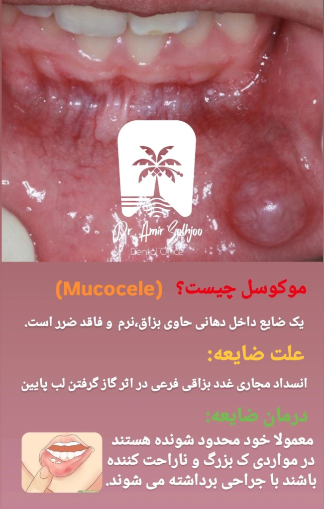 موکوسل