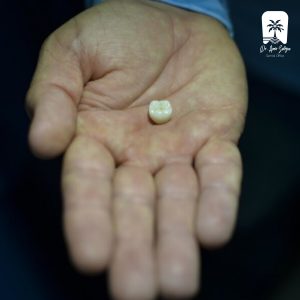 افتادن روکش دندان