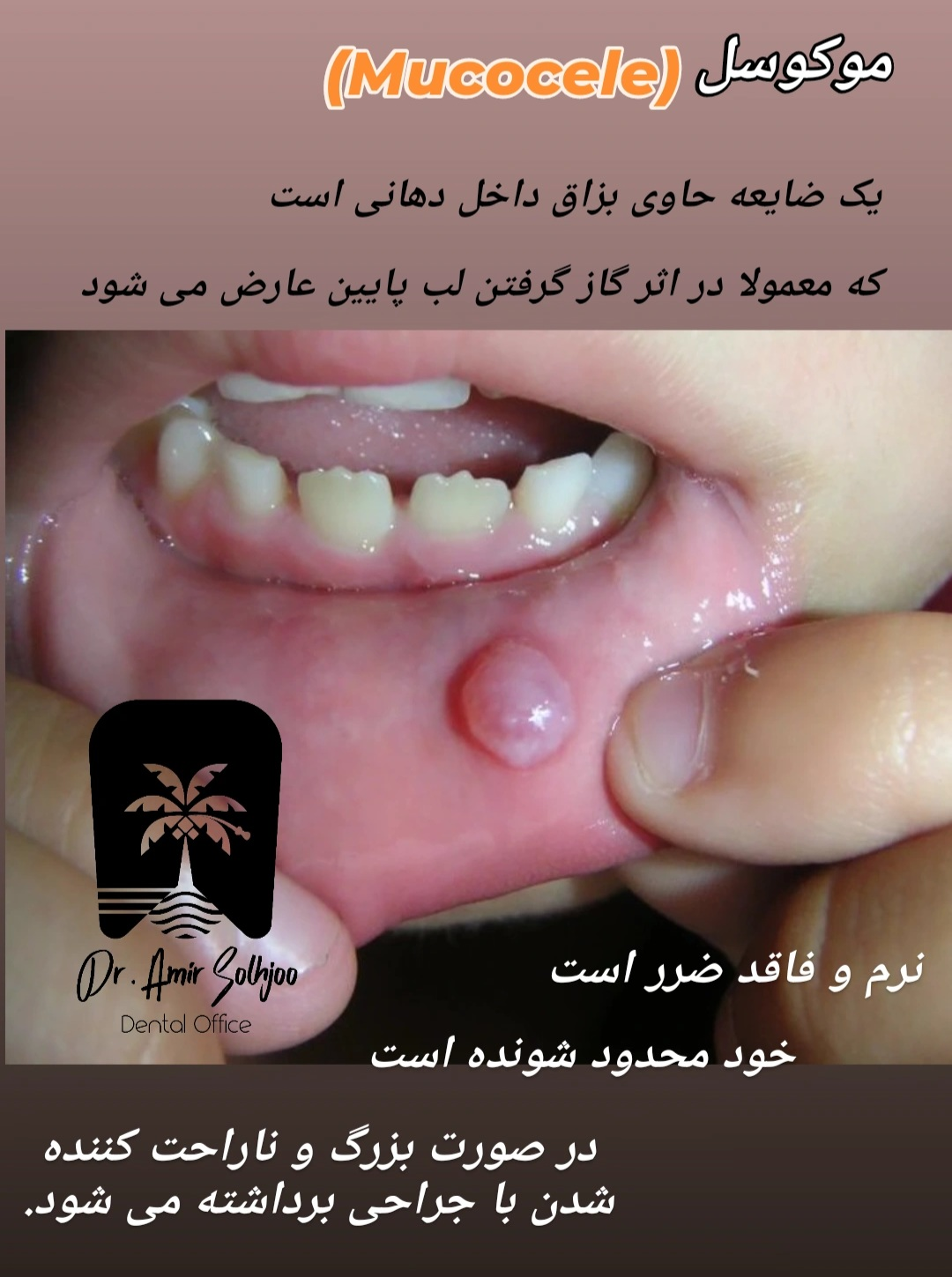 موکوسل