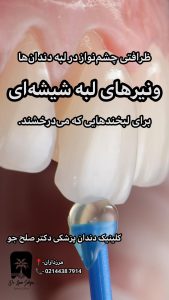کامپوزیت ونیر لبه شیشه‌ای در مرزداران