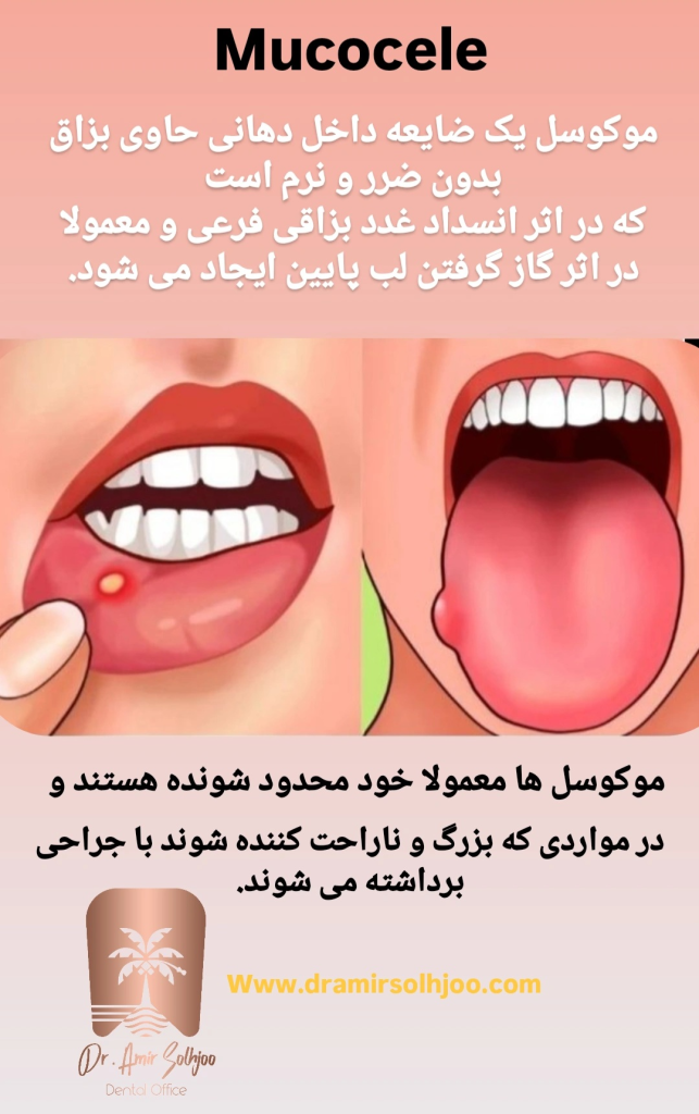 علت ایجاد موکوسل