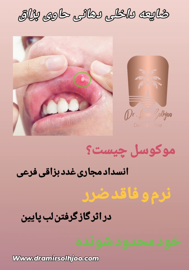 زیگیل دهانی