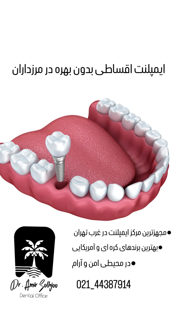 ایمپلنت اقساطی در مرزداران