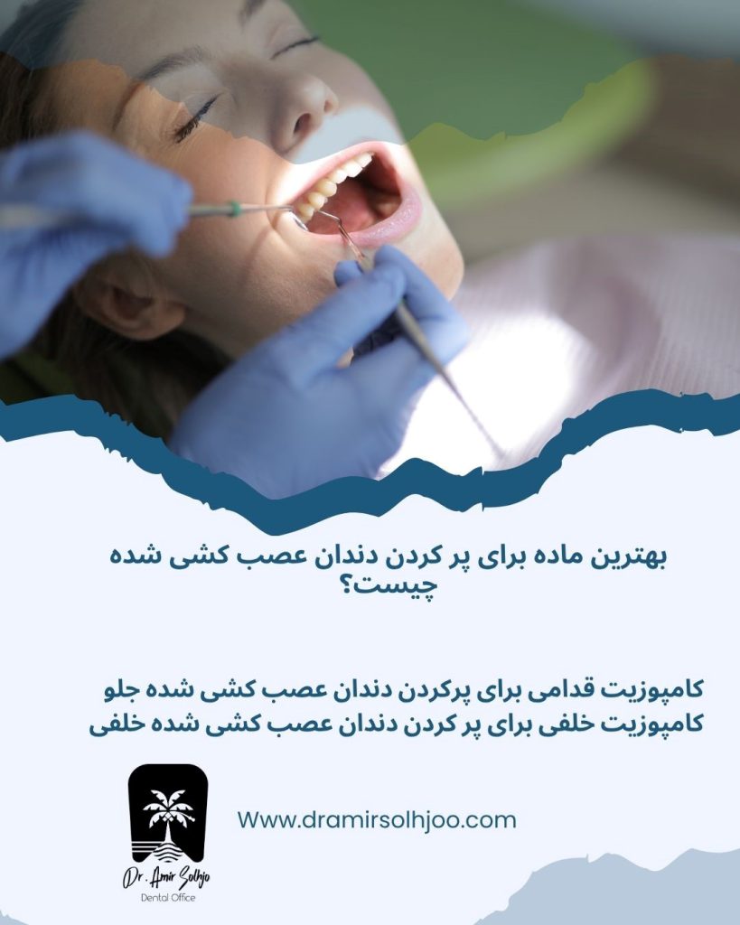 بهترین ماده برای پر کردن دندان