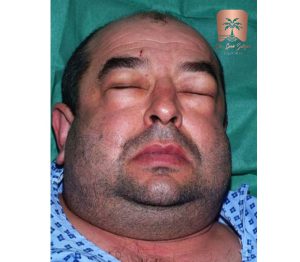 آمفیزم زیرپوستی