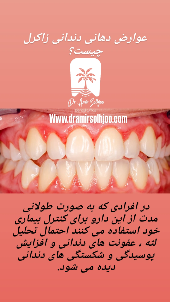 عوارض دهانی داروی زاکرل