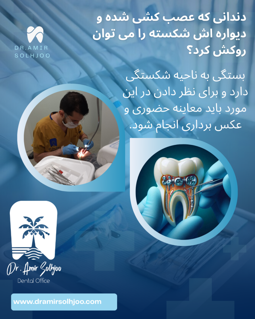روکش دندان عصب کشی شده