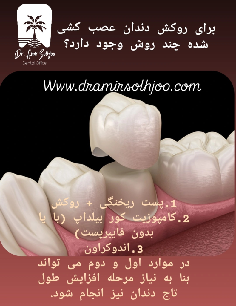 تعداد روکش دندان عصب کشی شده و قیمت عصب کشی و پرکردن دندان ۱۴۰۴