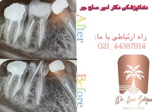 عکس رادیوگرافی عصبکشی دندان شماره 6