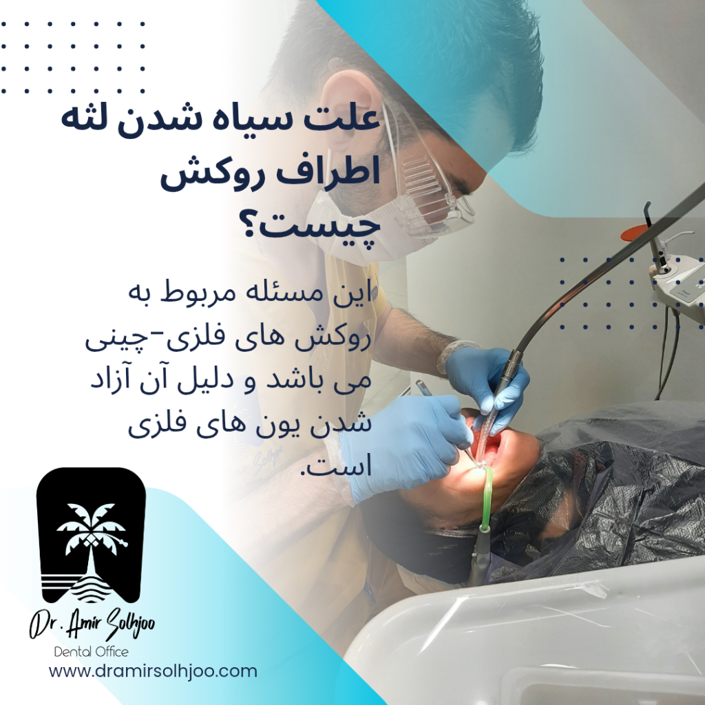 سیاه شدن لثه اطراف روکش دندان