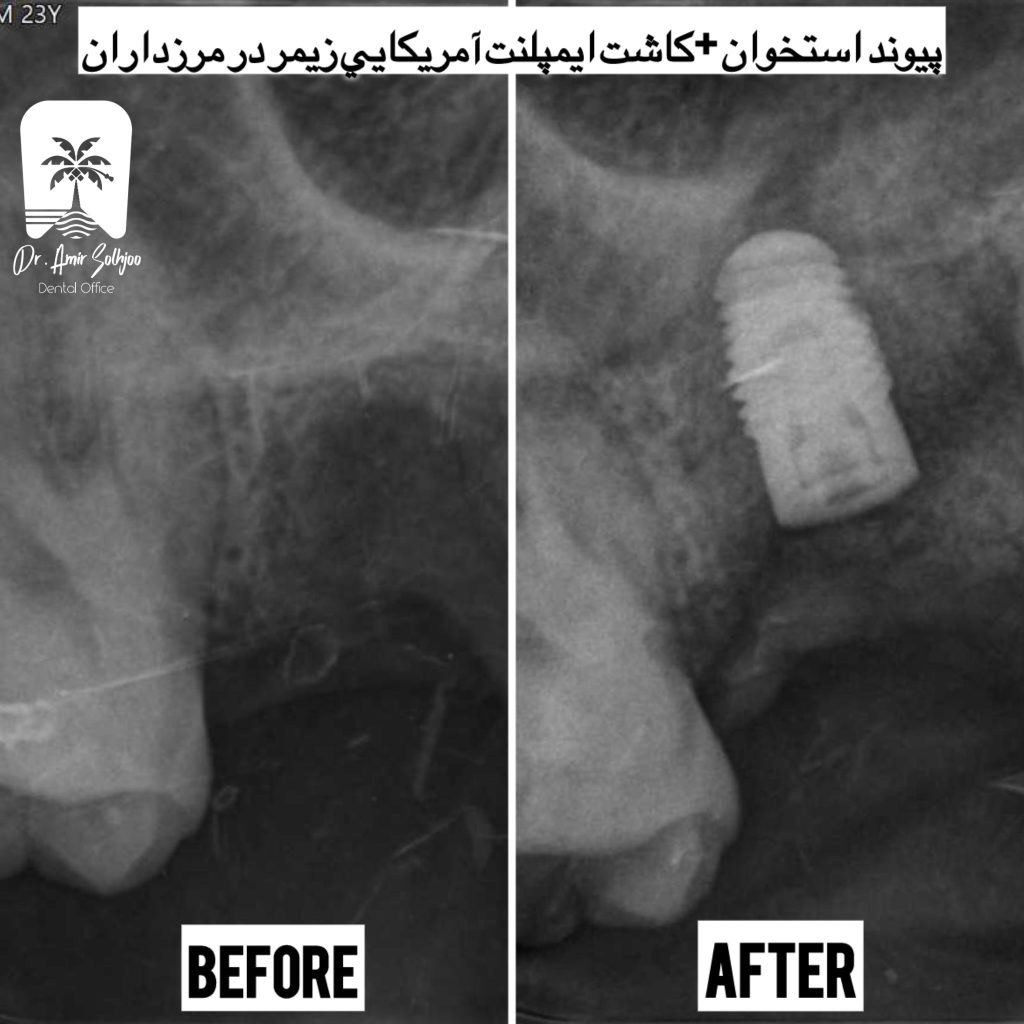 بهترین مرکز ایمپلنت تهران