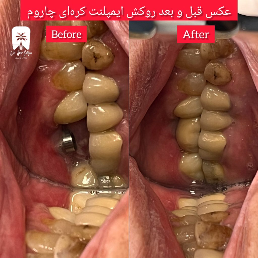 بهترین مرکز ایمپلنت تهران
