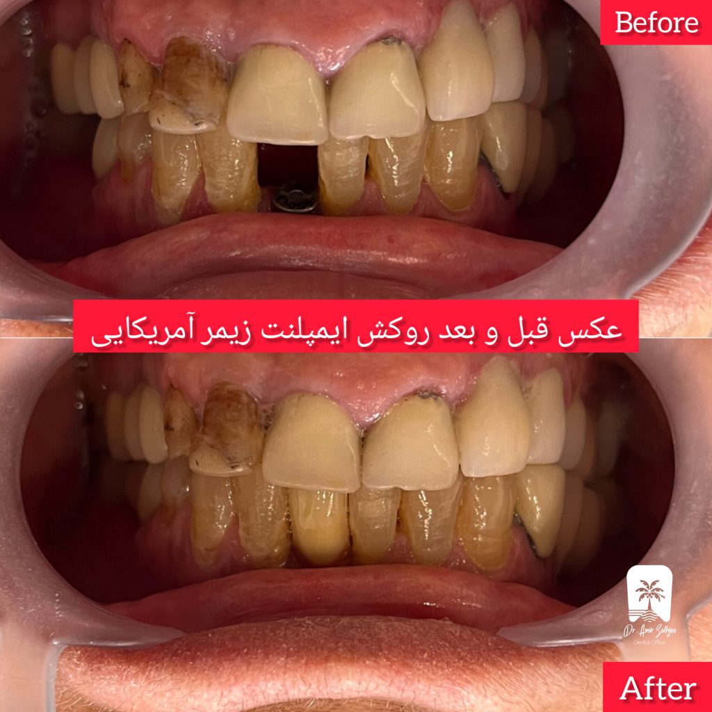 بهترین مرکز ایمپلنت تهران