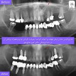 بهترین فوق تخصص ایمپلنت