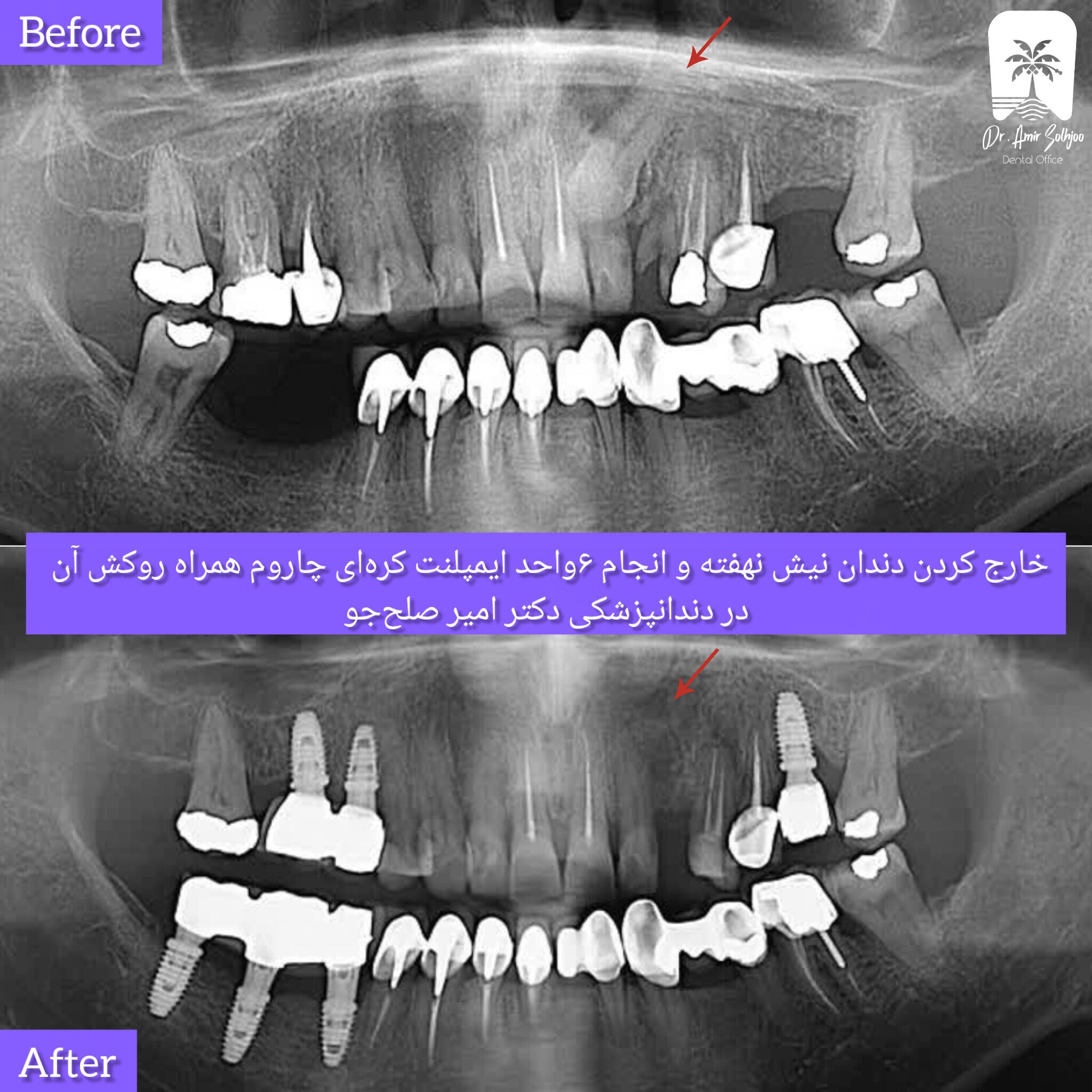 بهترین فوق تخصص ایمپلنت