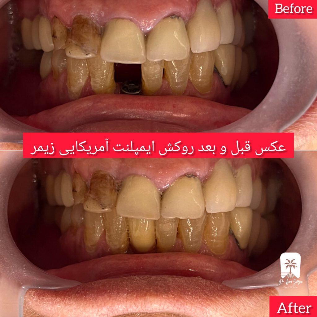 بهترین فوق تخصص ایمپلنت