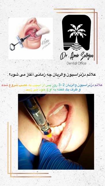 علائم دژنراسیون والریان