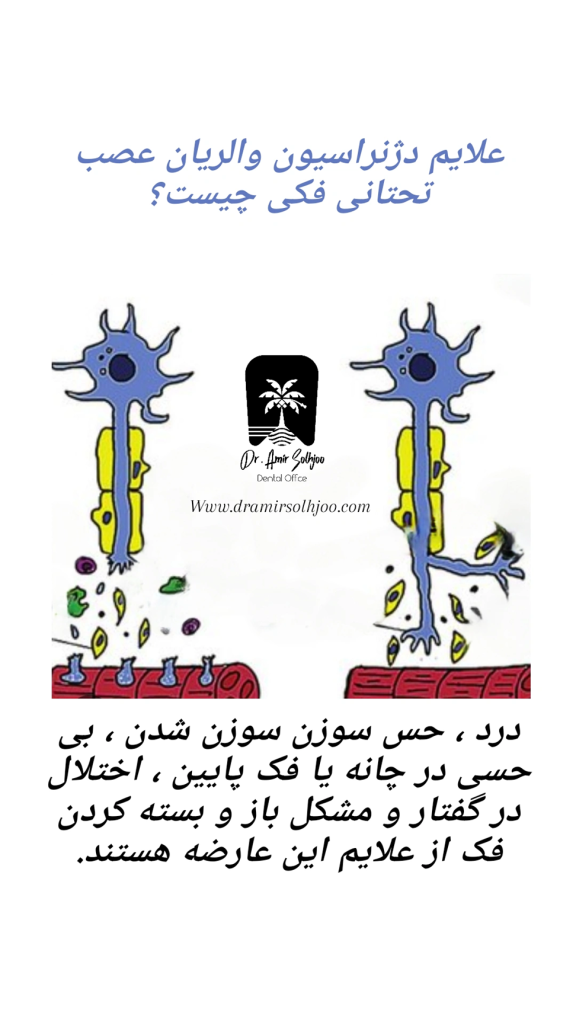 دژنراسیون والریان دندان Wallerian Degeneration