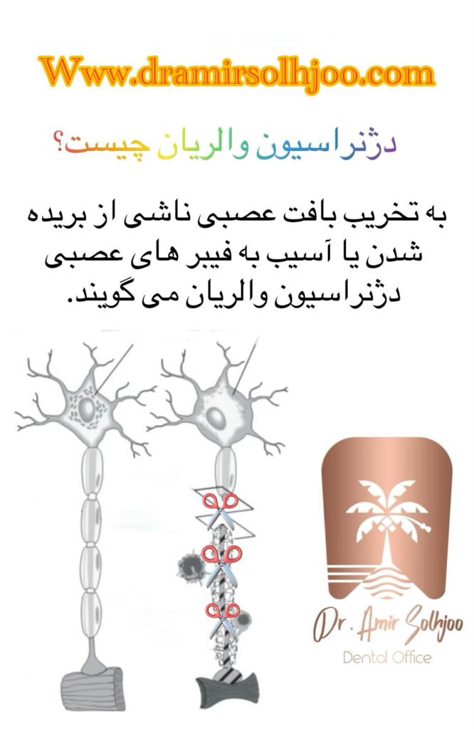 دژنراسیون والریان دندان