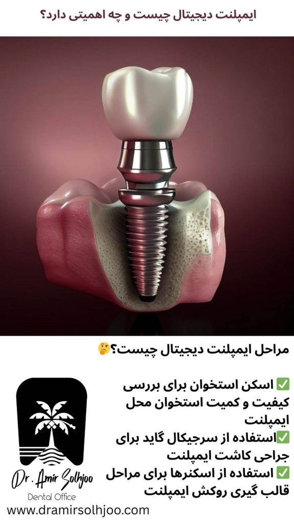 ایمپلنت دیجیتال چیست