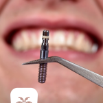 پس زدن ایمپلنت