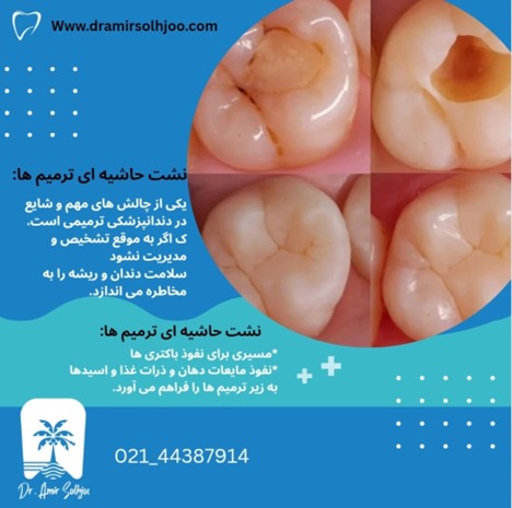 نشت حاشیه ای ترمیم ها