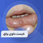 درمان موکوسل دهان