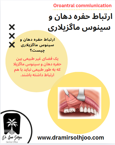 ارتباط حفره دهان و سینوس ماگزیلاری
