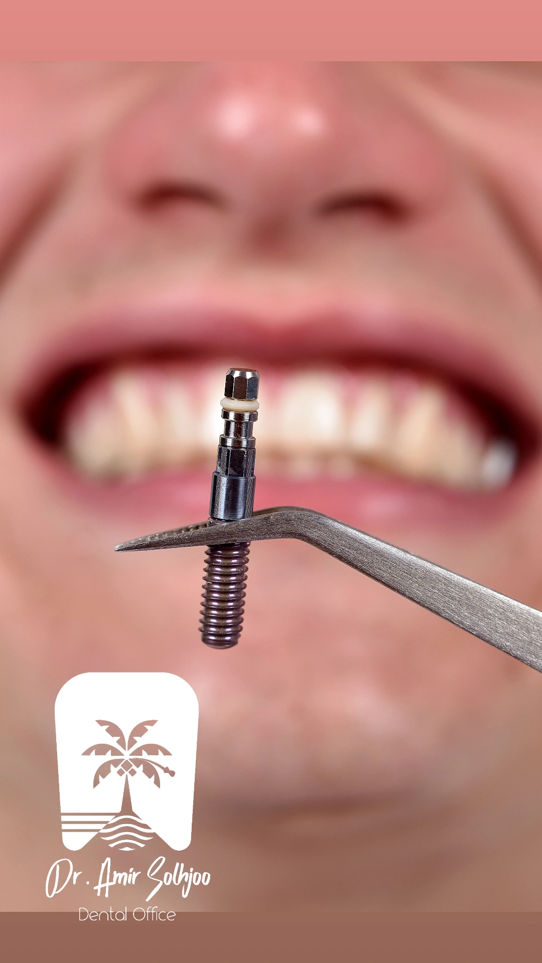 پس زدن ایمپلنت