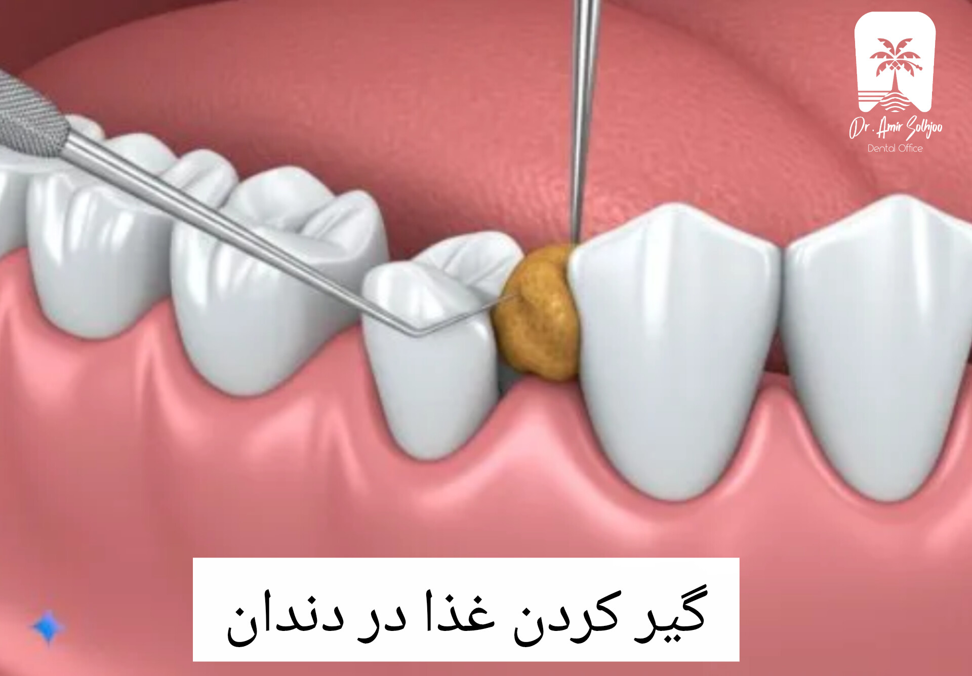 گیر کردن غذا لای دندان