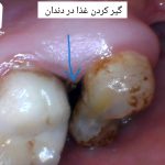 گیر کردن غذا لای دندان