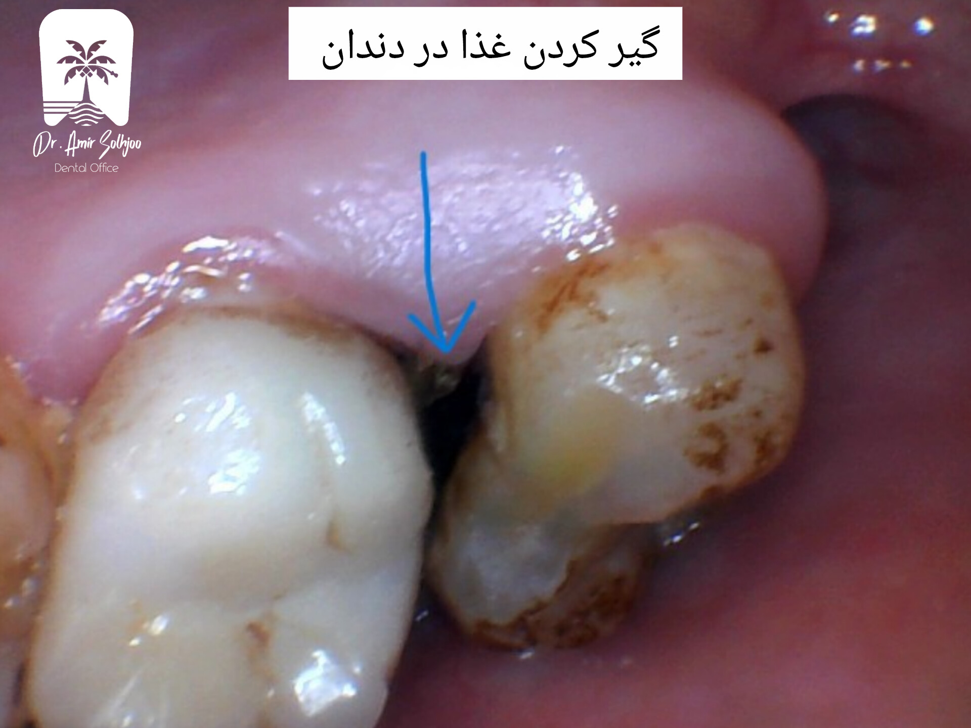 گیر کردن غذا لای دندان