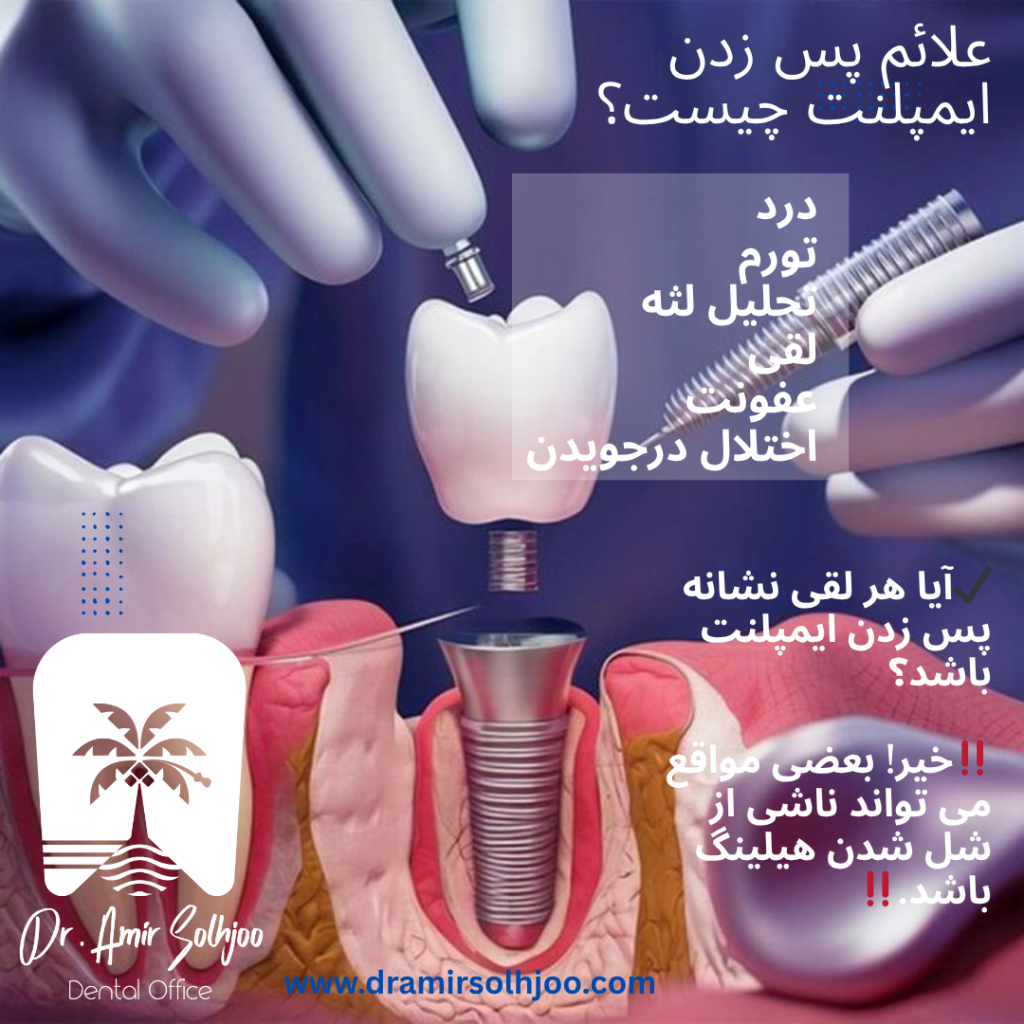 علائم پس زدن ایمپلنت